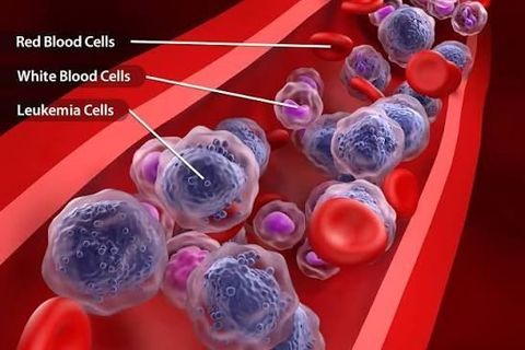 Acute Myeloid Leukemia Guide: Learn About AML Risk Factors, Diagnosis, and Treatment Approaches