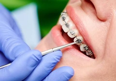 Guide to Orthodontics Insurance: Treatment Coverage, Eligibility Criteria, Policy Features and Planning Considerations