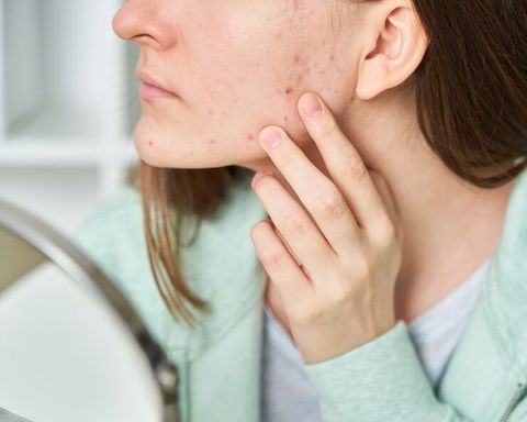 Acne and Blackheads Guide: Explore Causes, Symptoms, Skin Care, Treatments, and Prevention