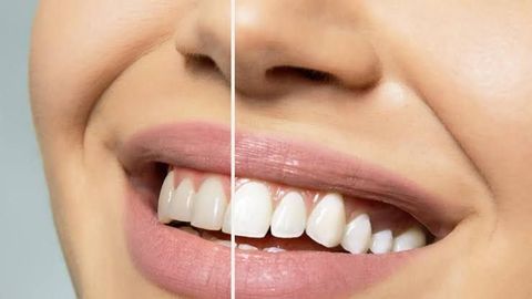 Teeth Whitening Treatment Compared: How to Choose the Right Option