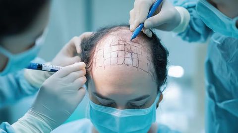 Hair Transplant Guide: Methods, Procedure, Recovery, Risks, Techniques, Hair Growth Process, Results,   and Key Considerations